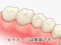 硬質レジン（前歯部）