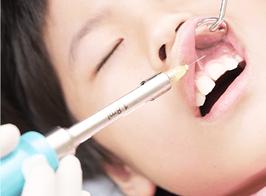 虫歯・歯周病の治療や抜歯には浸潤麻酔
