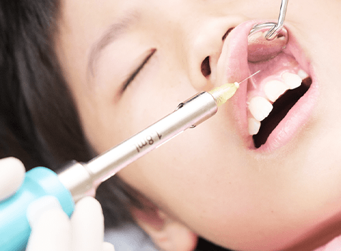 虫歯・歯周病の治療や抜歯には浸潤麻酔