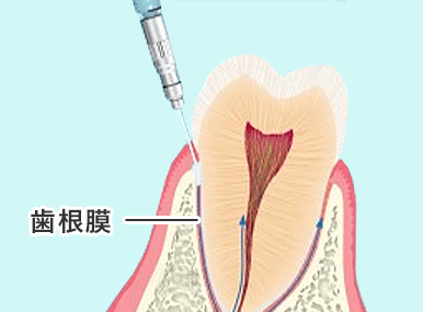 浸潤麻酔が効きにくい時は歯根膜注射