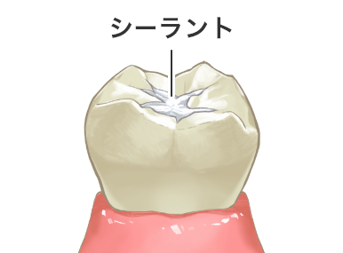 シーラント（予防填塞）で奥歯の予防