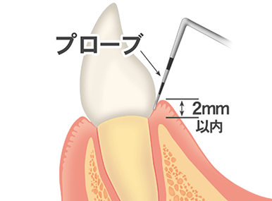 歯周病の進行と症状