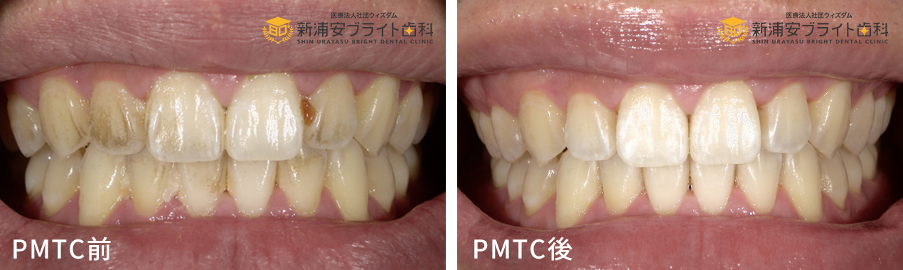 PMTC前後