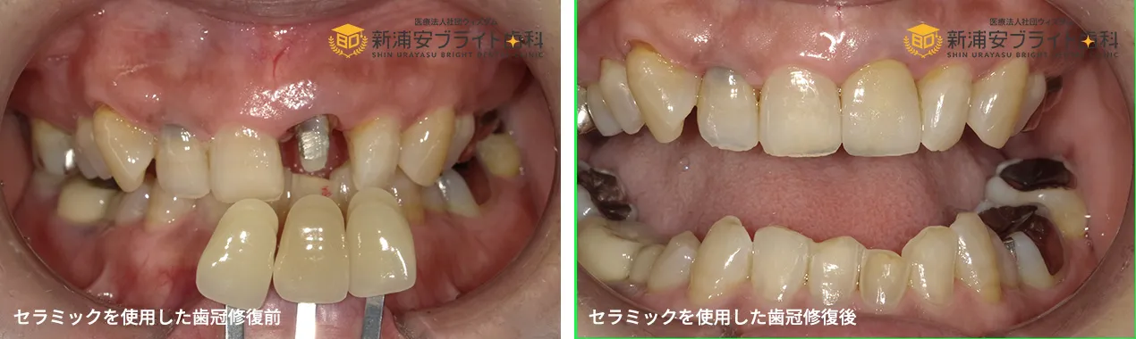 セラミッククラウン前